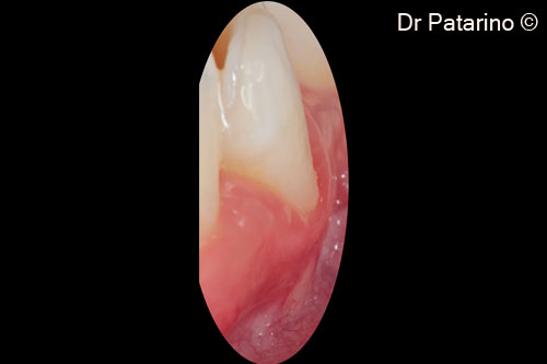 3 - Minimum thickness of the keratinized tissue