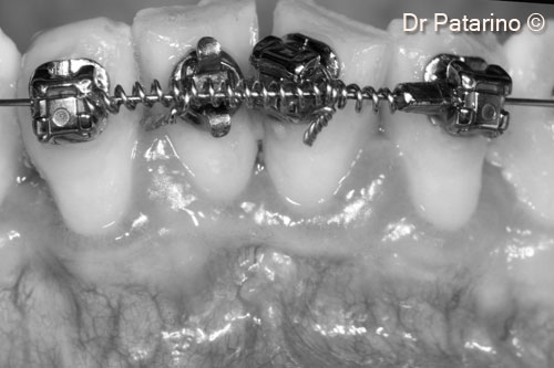 15 - B/w picture that enlightens the quantity of keratinized tissue and the mucogingival morphology