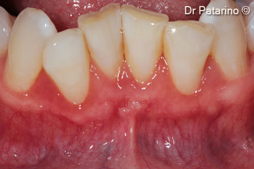 10 - Tissue healing at 4 months