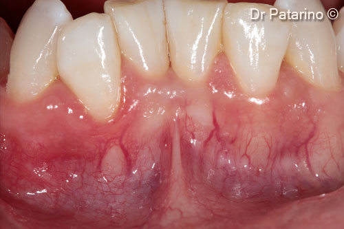 1 - Gingival recessions in the lower arch due to dental malposition and insufficient keratinized tissue, considering the aim of an orthodontic treatment