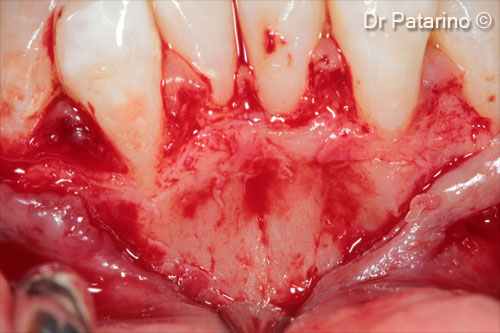 4 - Flap with releasing incisions