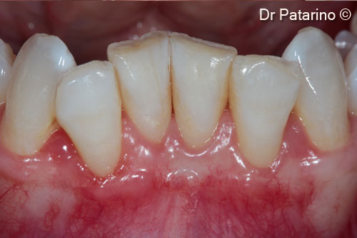 9 - Tissue healing at 2 months