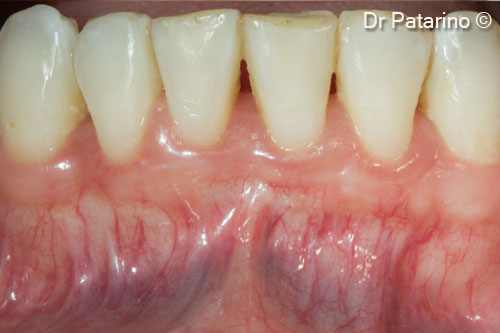 14 - Detail of 4 incisors