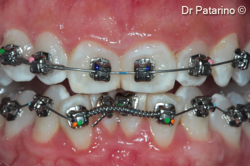 12 - Orthodontic treatment 10 months after mucogingival surgery
