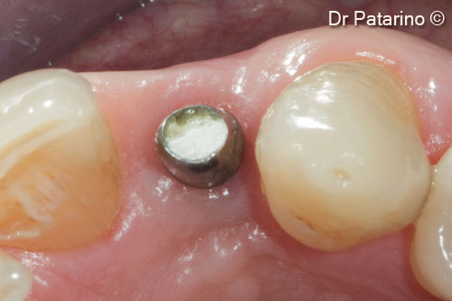 15 - Immediately before cementing prosthesis - Occlusal view