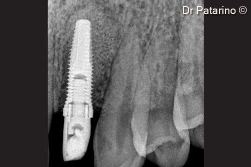 13 - Implant insertion with immediate loading