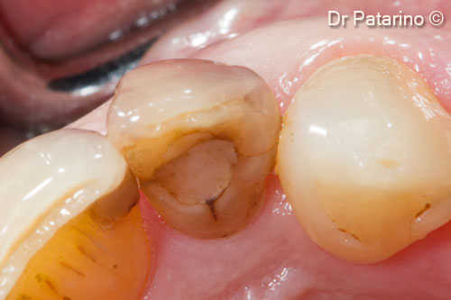 2 - Initial situation - Occlusal  view