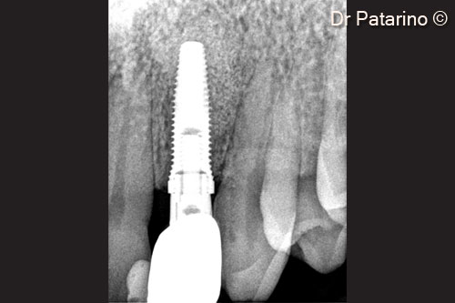 18 - Endoral x-ray