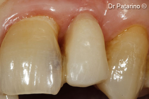 12 - Healing at 7 months before implant insertion