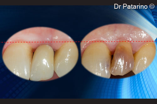 19 - Gain of keratinized tissue 12 months after surgery