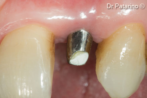 14 - Immediately before cementing prosthesis - Vestibular view