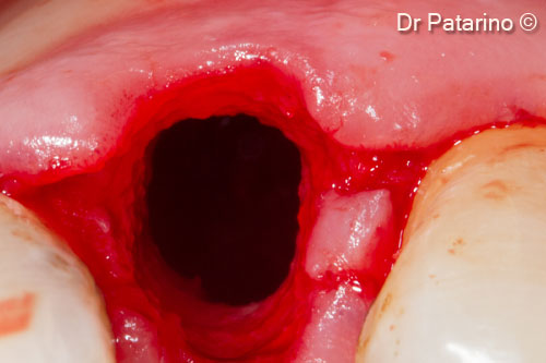 4 - Occlusal view after extraction and removal of granulation tissue