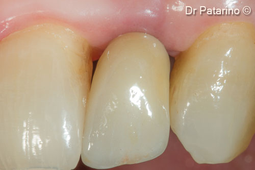 16 - Cemented prosthesis - Vestibular view