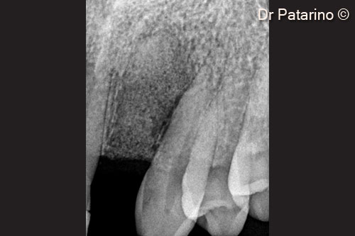 10 - Endoral x-ray after grafting