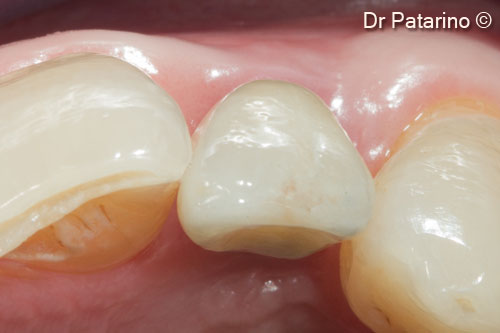 17 - Cemented prosthesis - Occlusal view