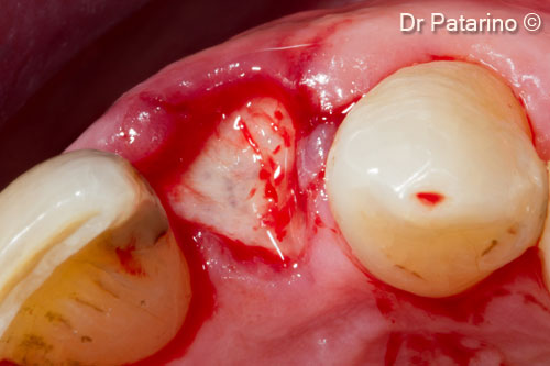 7 - OsteoBiol<sup>®</sup> <i>Derma</i> inserted under the gingival margin vestibular in order to preserve the gingival papilla