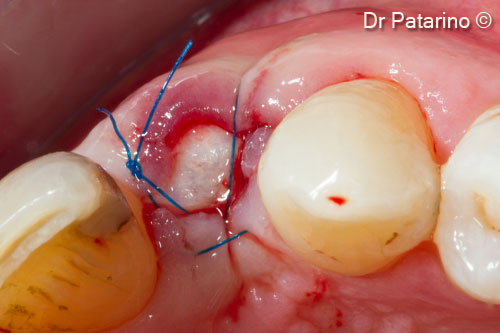 8 - Suture - Occlusal view
