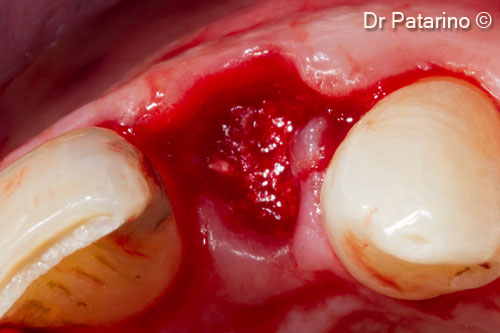 5 - Occlusal view after insertion of OsteoBiol<sup>®</sup> <i>Gen-Os</i><sup>®</sup>  graft up to the margin of the residual bone crest