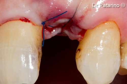 9 - Suture - Vestibular view