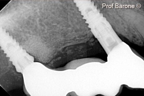 8.  Peri-apical radiograph 2 years after implant placement and bone augmentation