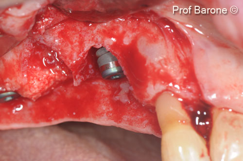 2. Implant inserted with a residual vertical and horizontal bone defect