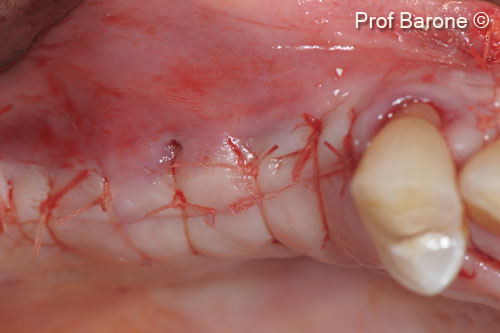 5. Sutures