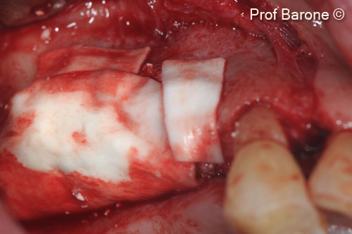 4. Collagen Membrane (<i>Evolution</i> standard) used to cover the bone graft