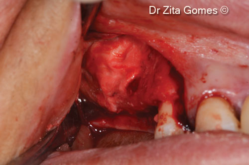 8. Finishing the filling of the sinus with OsteoBiol<sup>®</sup> <i>Putty</i>
