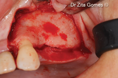 11. Full thickness mucoperiosteal flap with mesial release incision, to access the left maxillary sinus