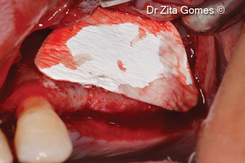 Clinical case of bilateral sinus lift...