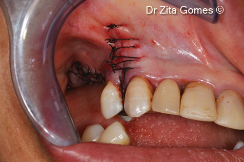 10. Suture of the flap with polyamide 4(0) suture with simple stitches