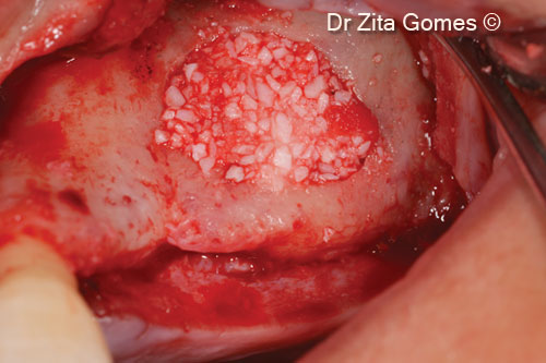 15. Finishing the filling of the sinus