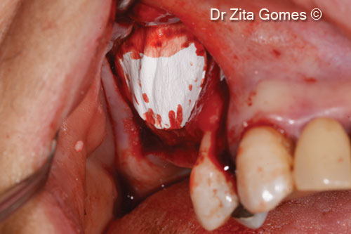 9. Protecting the xenograft with OsteoBiol<sup>®</sup> <i>Evolution</i>