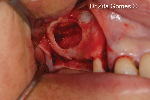 5. Raising of the Schneiderian membrane creating the space for the graft