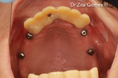 18. Four dental implants (2 in each sinus) were placed after 8 months of healing. Rehabilitation with fixed ceramic bridges after 3 months