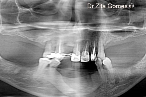 1. Initial panoramic X-ray, showing pneumatization of both maxillary sinuses