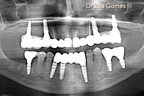 21. Panoramic final X-ray at 5-year follow up