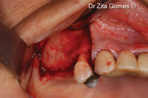 3. Full thickness mucoperiosteal flap with mesial release incision, to access the right maxillary sinus