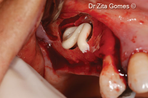 7. Beginning filling the lifted sinus with OsteoBiol<sup>®</sup> <i>Putty</i>