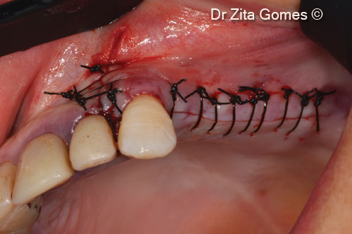 17. Suture of the flap with polyamide 4(0) suture with simple stitches
