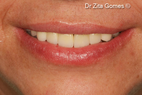 20. Patient smile after the rehabilitation