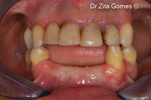 2. Initial intra-oral situation