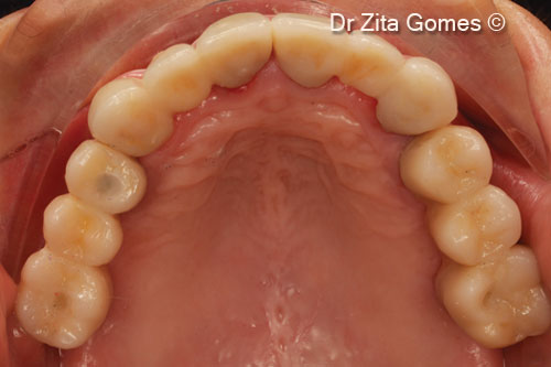 19. Final fixed oral rehabilitation with bridges over implants in the posterior regions and ceramic crows on the anterior teeth (occlusal view)