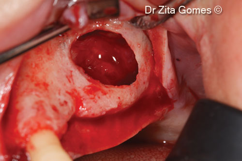 13. Raising of the Schneiderian membrane of the sinus, creating the space for the graft