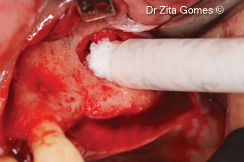 14. Beginning filling the lifted sinus with OsteoBiol<sup>®</sup> <i>mp3</i><sup>®</sup>