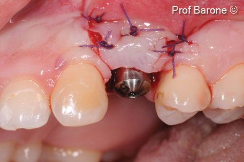 15. Second stage of surgery, apically positioned flap to rebuild a correct soft tissue architecture