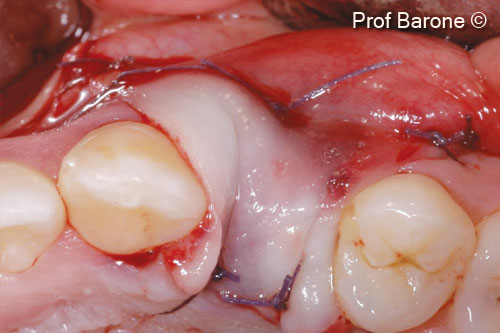5. Primary soft tissue closure was obtained