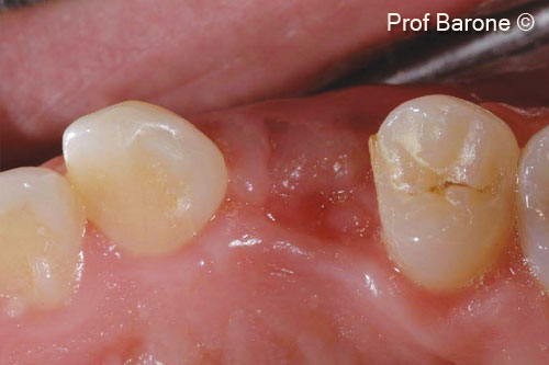 7. Soft tissue healing 6 weeks after the ridge augmentation procedure. Occlusal view