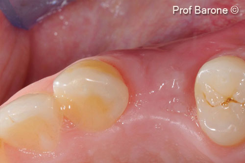 14. Soft tissue healing 3 months after implant placement, tooth position #24