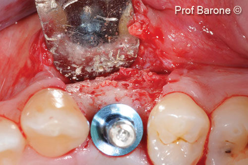 11. Implant placement in a prosthetically driven position, occlusal view